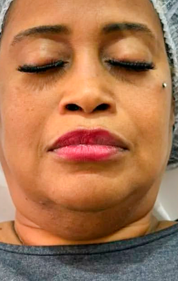 Antes do tratamento 2