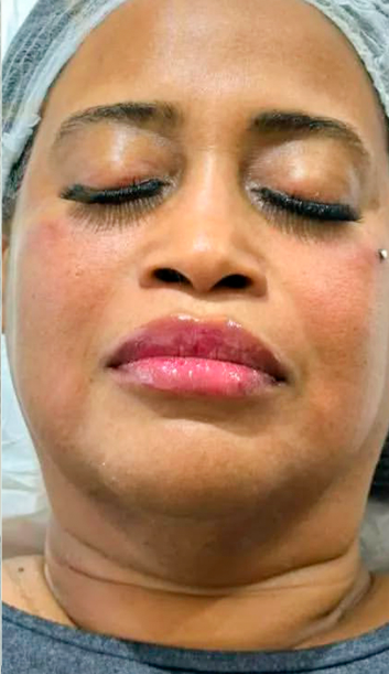 Depois do tratamento 2