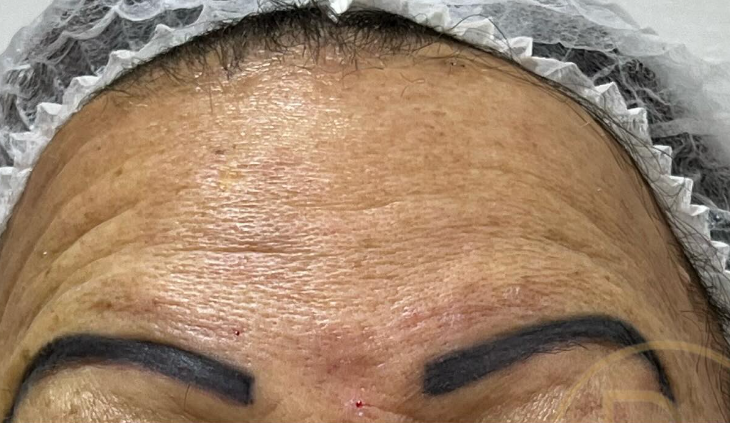 Antes do tratamento 3