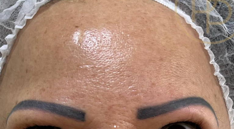 Depois do tratamento 3